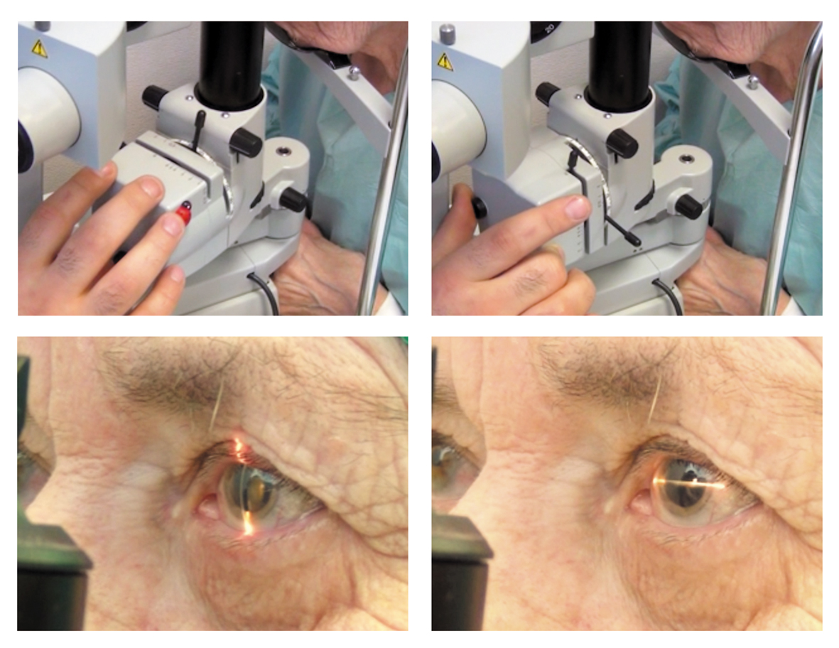 Симптомы и диагностика катаракты глаза